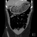 Gastric Bezoar 2 Creative Commons images