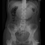 Gastric Bezoar 3 Creative Commons images