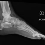 Calcaneal Fractures and Böhler’s Angle 1 Creative Commons images