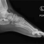 Calcaneal Fractures and Böhler’s Angle 2 Creative Commons images