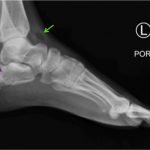 Calcaneal Fractures and Böhler’s Angle 3 Creative Commons images