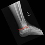 Calcaneal Fractures and Böhler’s Angle 4 Creative Commons images