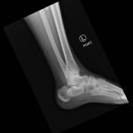 Calcaneal Fractures and Böhler’s Angle 6 Creative Commons images