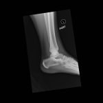 Calcaneal Fractures and Böhler’s Angle 7 Creative Commons images