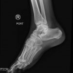 Calcaneal Fractures and Böhler’s Angle 8 Creative Commons images