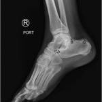 Calcaneal Fractures and Böhler’s Angle 9 Creative Commons images