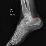 Calcaneal Fractures and Böhler’s Angle 10 Creative Commons images