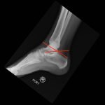 Calcaneal Fractures and Böhler’s Angle 11 Creative Commons images