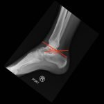 Calcaneal Fractures and Böhler’s Angle 12 Creative Commons images