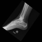 Calcaneal Fractures and Böhler’s Angle 13 Creative Commons images
