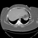 Ventriculoperitoneal Shunt Migration 2 Creative Commons images
