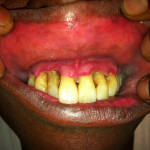 Acute Necrotizing Ulcerative Gingivitis (ANUG) 2 Creative Commons images