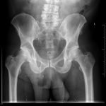 Bowel Perforation complicating an incarcerated inguinal hernia 1 Creative Commons images