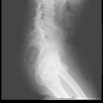 Bowel Perforation complicating an incarcerated inguinal hernia 2 Creative Commons images