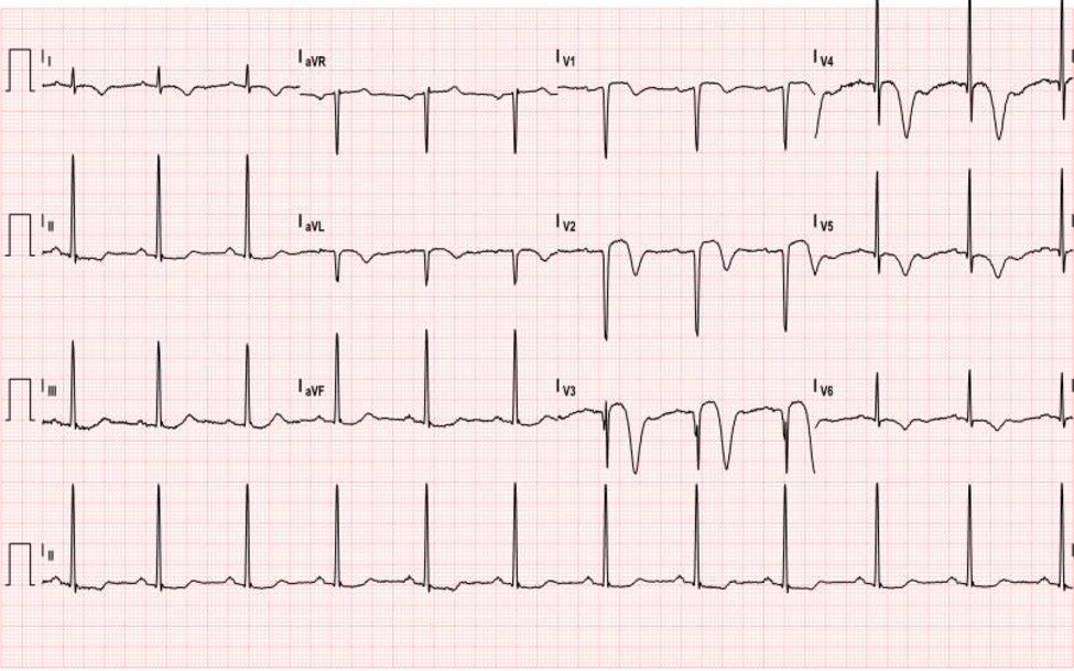 Wellens’ Sign (Wellens’ Syndrome) 1 Creative Commons images
