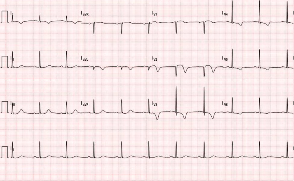 Wellens’ Sign (Wellens’ Syndrome) 2 Creative Commons images