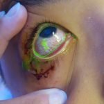 Corneal Sparing Conjunctival Abrasion 1 Creative Commons images