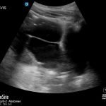 Perforated Gastric Ulcer with Intra-abdominal Abscess 4 Creative Commons images