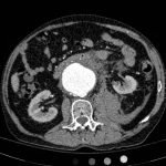 Ruptured Abdominal Aortic Aneurysm 3 Creative Commons images