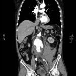 Ruptured Abdominal Aortic Aneurysm 2 Creative Commons images