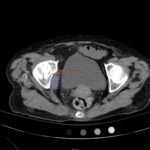 Acetabular Fracture 2 Creative Commons images