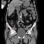 Acetabular Fracture 7 Creative Commons images