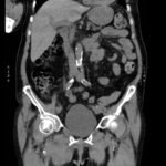 Acetabular Fracture 14 Creative Commons images