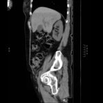 Acetabular Fracture 12 Creative Commons images