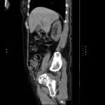 Acetabular Fracture 11 Creative Commons images