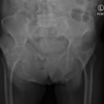 Acetabular Fracture 8 Creative Commons images