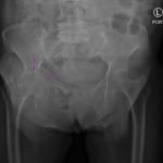 Acetabular Fracture 1 Creative Commons images