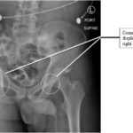 Bilateral Hip Dislocation in Unrestrained Driver 2 Creative Commons images