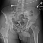 Bilateral Hip Dislocation in Unrestrained Driver 4 Creative Commons images