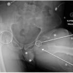 Bilateral Hip Dislocation in Unrestrained Driver 1 Creative Commons images