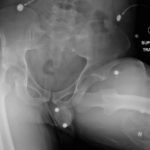 Bilateral Hip Dislocation in Unrestrained Driver 3 Creative Commons images