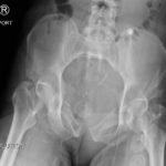 Open Book Pelvic Fracture 2 Creative Commons images