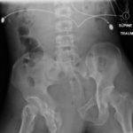 Open Book Pelvic Fracture 1 Creative Commons images