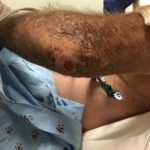 Subcutaneous Emphysema in Non-Necrotizing Soft Tissue Injury 3 Creative Commons images