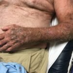 Subcutaneous Emphysema in Non-Necrotizing Soft Tissue Injury 4 Creative Commons images