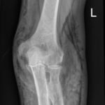 Subcutaneous Emphysema in Non-Necrotizing Soft Tissue Injury 1 Creative Commons images