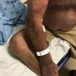 Subcutaneous Emphysema in Non-Necrotizing Soft Tissue Injury 5 Creative Commons images