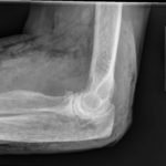 Subcutaneous Emphysema in Non-Necrotizing Soft Tissue Injury 2 Creative Commons images