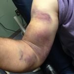 Biceps Tendon Rupture 1 Creative Commons images