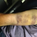 Biceps Tendon Rupture 2 Creative Commons images