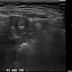 Intussusception 1 Creative Commons images