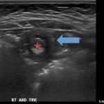 Intussusception 2 Creative Commons images