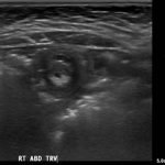 Intussusception 3 Creative Commons images