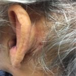 Ramsay Hunt Syndrome 1 Creative Commons images