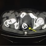 Procedural Sedation for the removal of a rectal foreign body 1 Creative Commons images