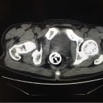 Procedural Sedation for the removal of a rectal foreign body 3 Creative Commons images